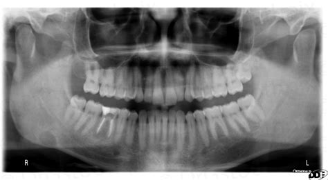 Stafne Defect Dr Gs Toothpix
