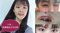 割雙眼皮分享 | Double Eyelid Surgery - YouTube