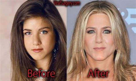 Jennifer Aniston Plastic Surgery Before And After Nose Job Pictures