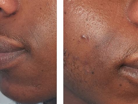 Bilateral Symmetrical Oval Hyperpigmentation On The Face A Case Of