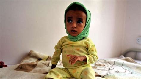 Fast 14 Millionen Kindern In Vier Ländern Droht Hungertod