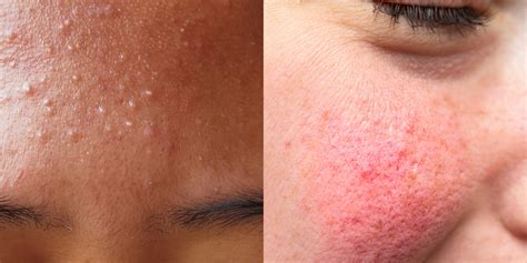 Acne Vs Rosacea Whats The Difference Curology