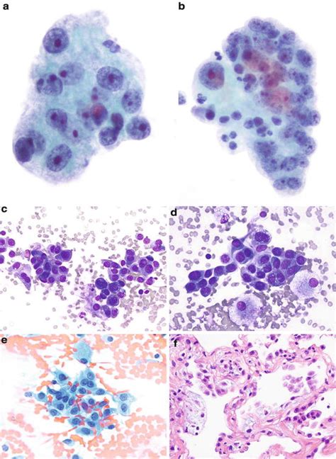 Mimickers Of Lung Carcinoma In Cytology And Small Biopsy Specimens