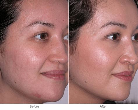 Acne Scar Treatment In St Louis Microdermabrasion And Skin Rejuvenation