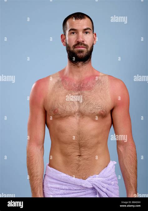 A Sunburnt Man Stock Photo Alamy