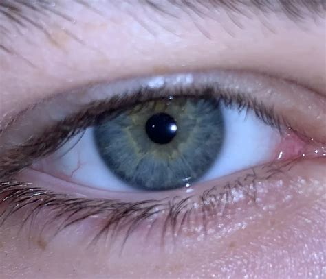 Was Told To Post Here Gray W Central Heterochromia Reyes