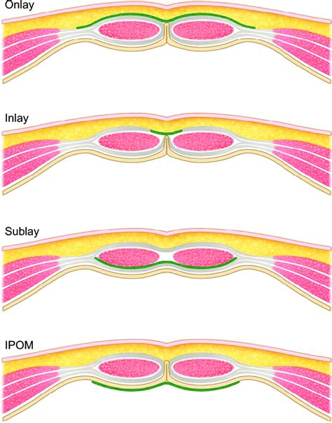 several techniques of mesh repair for incisional or ventral hernia download scientific diagram