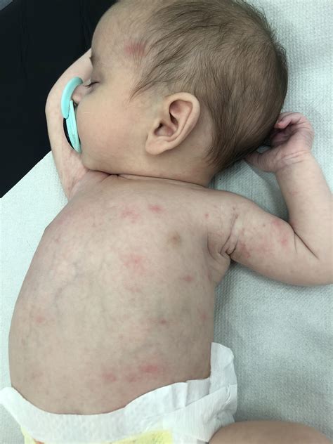 Mother Watched In Horror Meningitis Rash Spread Across Her Babys Body