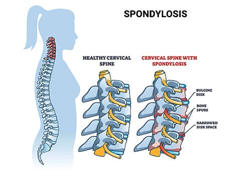Spondylosis Nyc And Nj
