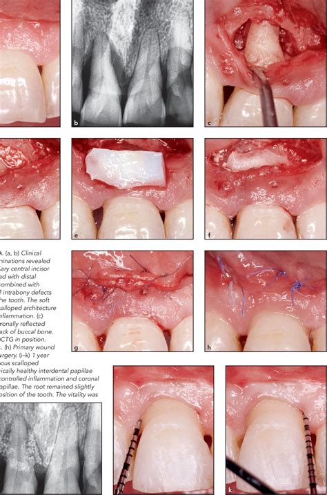 Pdf Connective Tissue Grafts With Nonincised Papillae Surgical