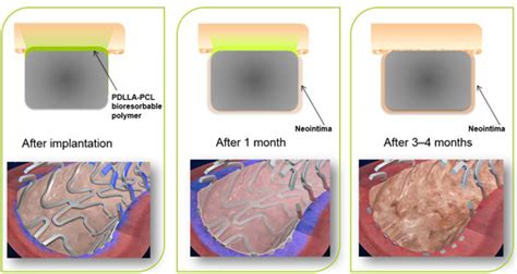 Ultimaster Drug Eluting Stent