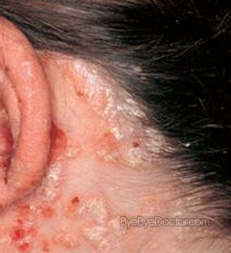 Scalp Psoriasis Symptoms Symptoms Causes Treatment And Prevention Of