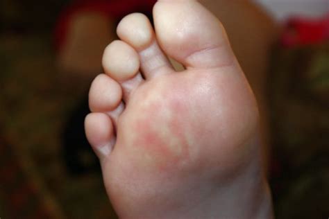 Middle Of The Toe Pad Center Top Of Each Footred Rash Patches