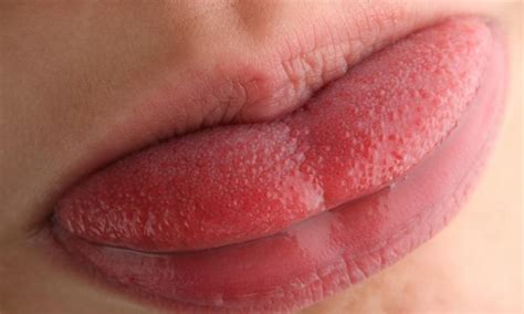 Swollen Taste Buds Inflamed Papillae On Back Of Tongue Sides