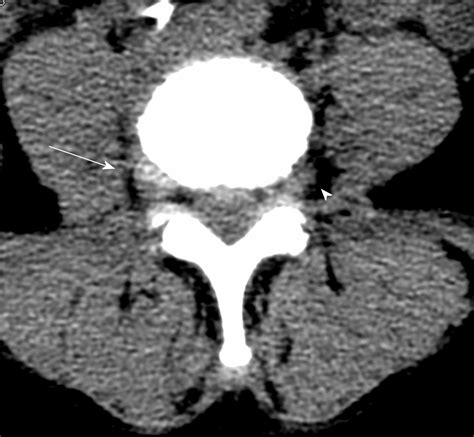 Far Lateral Lumbar Disc Herniation Part 1 Imaging Neurophysiology And