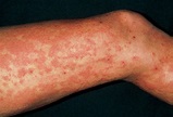 Urticaria Rash (hives) On Legs Due To Exam Stress Photograph by Dr P ...