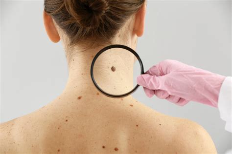 Skin Cancer And Sun Damage Moles On The Body Largely Determined By