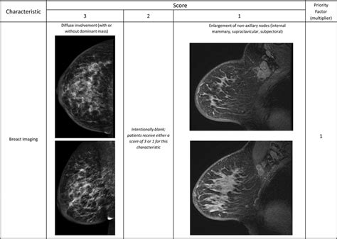 Imaging Characteristics Of Inflammatory Breast Cancer Variations Of