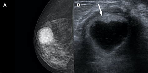 Complex Cystic Breast Masses An Ultrasound Imaging Review