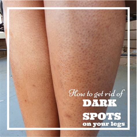 How To Get Rid Of Dark Spots On Your Legs Aka Strawberry Legs