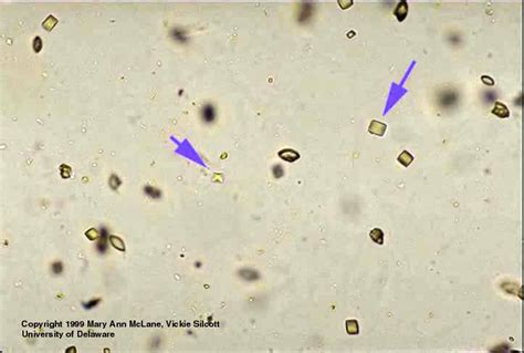 Receive all our future posts instantly in your inbox. Oxalate and Uric Acid Crystals in Acidic Urine | Medical ...