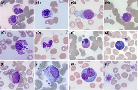 Abnormal White Blood Cell Morphology