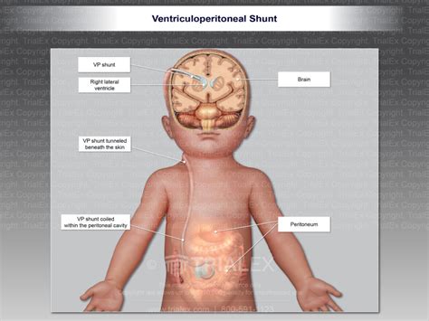 Ventriculoperitoneal Shunt In Infant Trialexhibits Inc