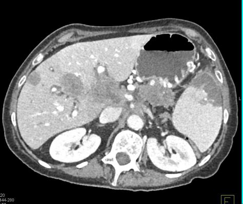 Pancreatic Adenocarcinoma With Liver Metastases And Splenic Infarcts