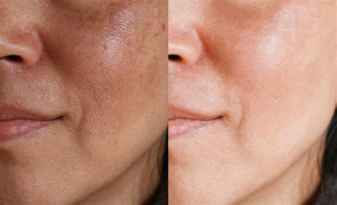 How To Get Rid Of Dark Spots On Face Beauty Crafter