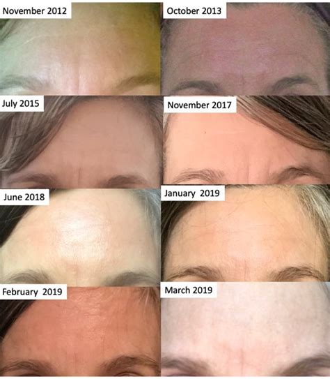 One Year Later Natural Methods To Smooth Forehead Muscles For Results