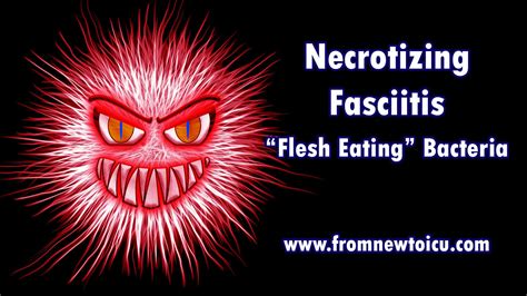 Necrotizing Fasciitiswhat Is It And How Do We Treat It — From New