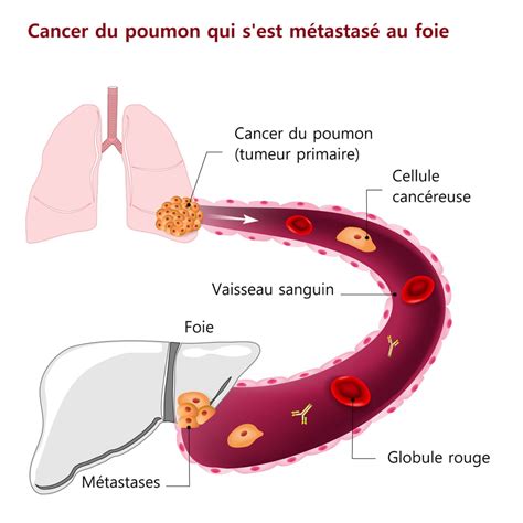 Cancer De La Peau Stade 3 Chance De Survie Communauté Mcms