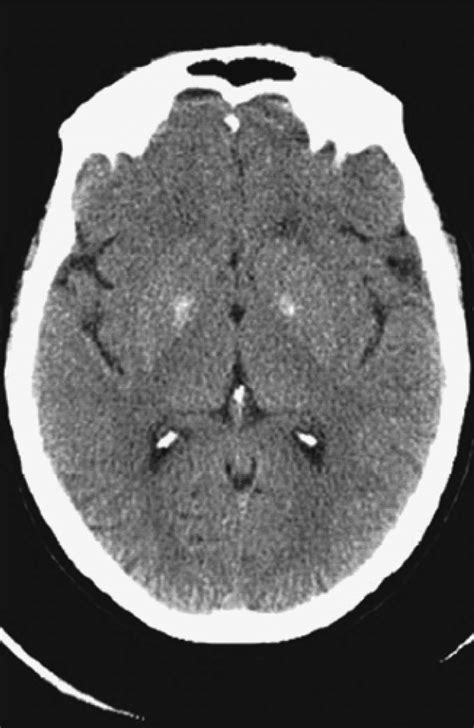 Ct Scan Of The Brain Showing Bilateral Hyperdense Lesions In Basal