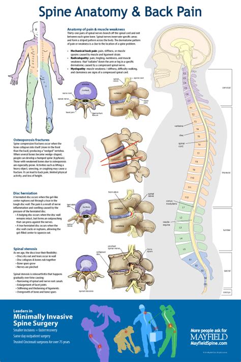 Spine Anatomy And Back Pain Poster On Aiga Member Gallery