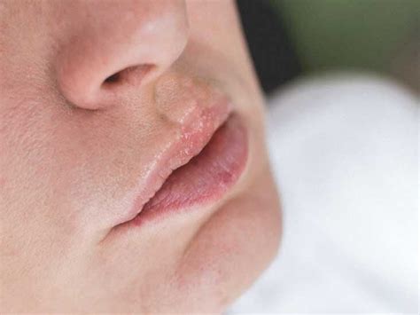 Sulfa Allergy Swelling Lips