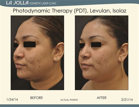 Patient Treated With Pdt Levulan And Isolaz At La Jolla Cosmetic Laser