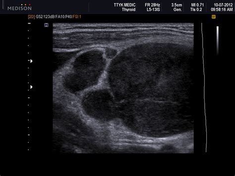 Vietnamese Medic Ultrasound Case Left Supraclavicular Nodes