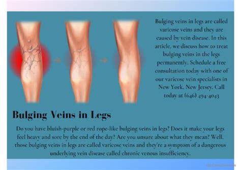 How To Treat Bulging Veins In Legs D English Esl Powerpoints