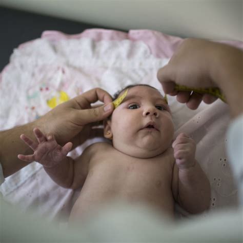 Zika Likely Causing Brazils Infant Birth Defects Cdc Says