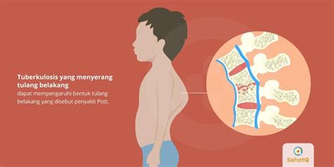 Tuberkulosis Tulang Belakang Tanda Dan Gejala Penyebab Cara Hot