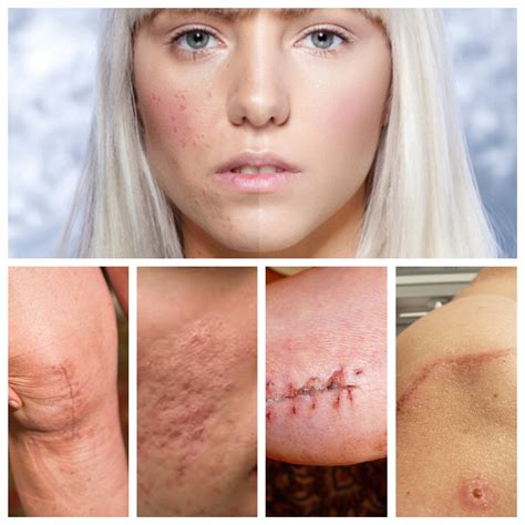 Do You Want To Get Rid Of Your Scars