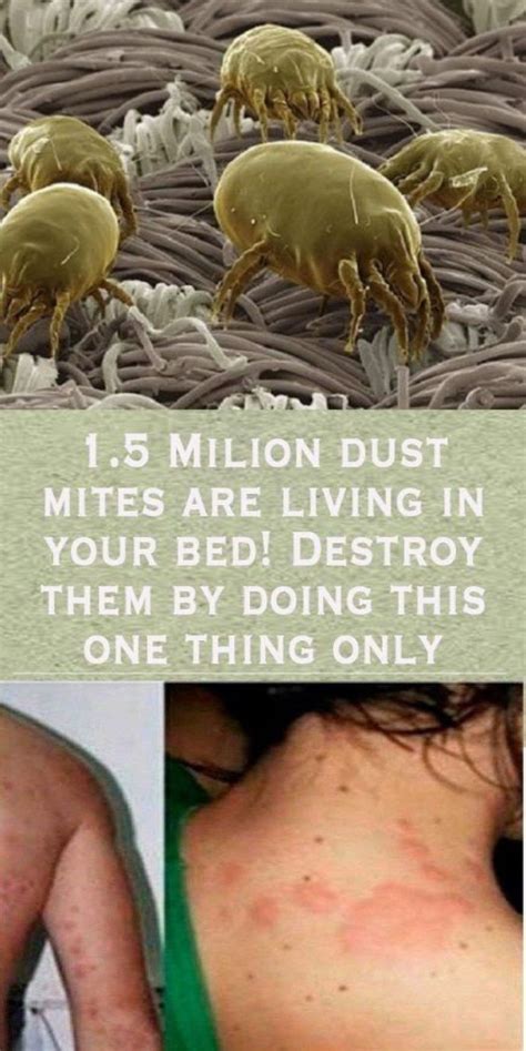 67 Amazing What Mites Can Live On Humans Insectza