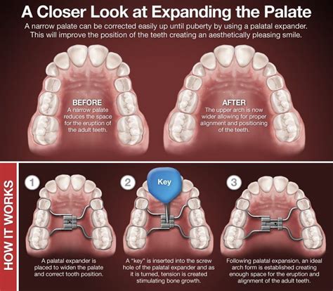 Palatal Expanders Create More Space In A Childs Mouth By Gradually