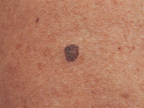 Moles A Guide To Identifying Skin Cancer And Hyperpigmentation