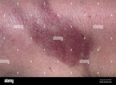 Hematoma Arm Hi Res Stock Photography And Images Alamy