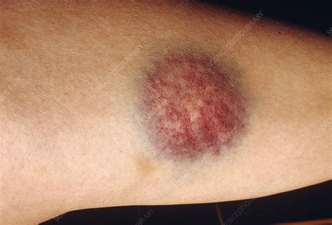 Bruise On Thigh Stock Image M3301341 Science Photo Library