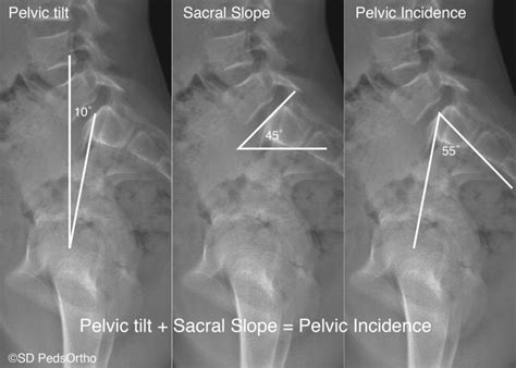 Lateral Radiograph Indicating The Method Of Measurement For Pelvic