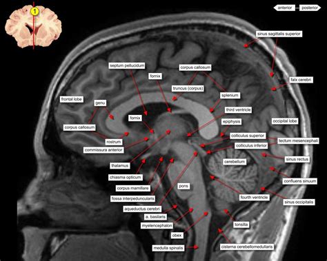 Sagittal Brain Mri Anatomy