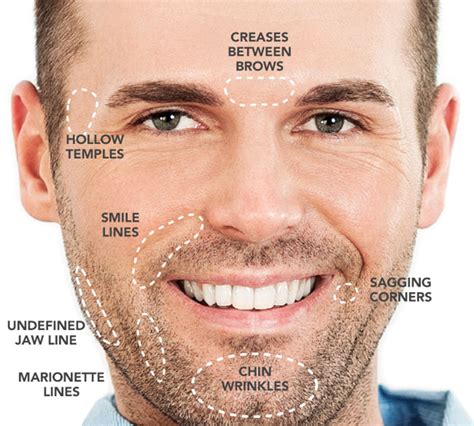 Dermal Fillers For Men Softening And Correcting In Midtown Toronto