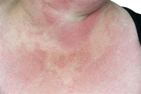 Rash From Drug Allergy Stock Image C0106671 Science Photo Library
